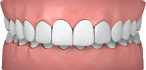 common-cases-overly-crowded-teeth