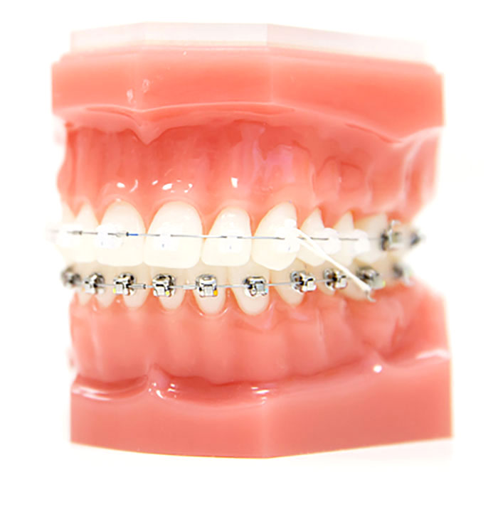 self-ligating-braces-on-denture