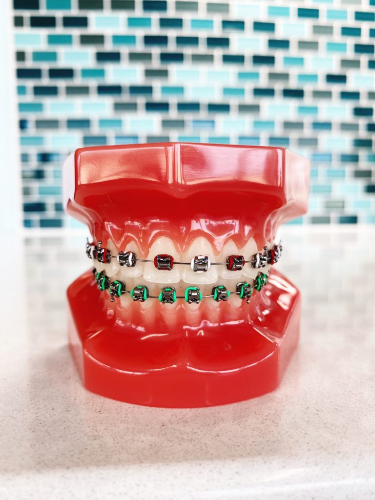 Braces Rubber Band Colors: Neon green, bright red and white