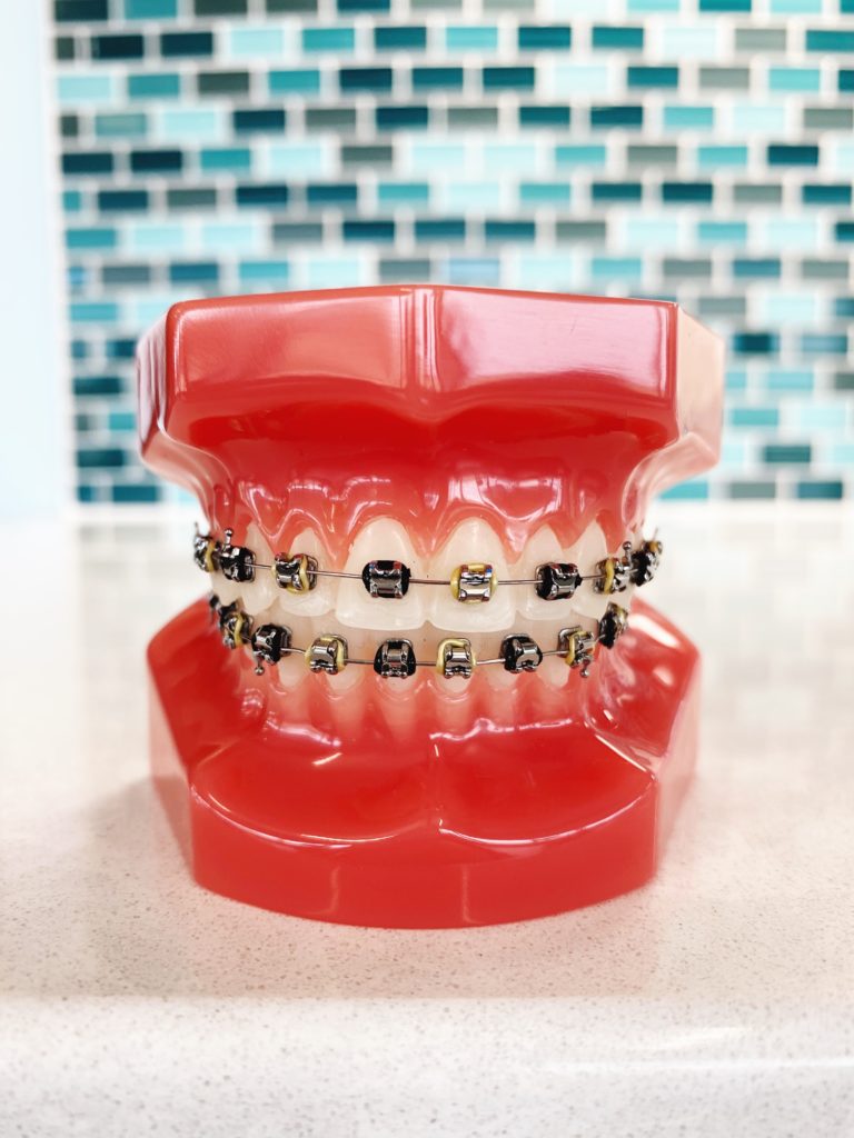 Braces Rubber Band Colors: Black and gold