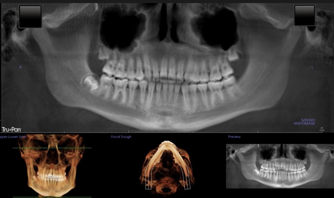 Impacted Canines